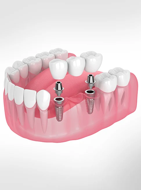 What Are Implant-Supported Bridges