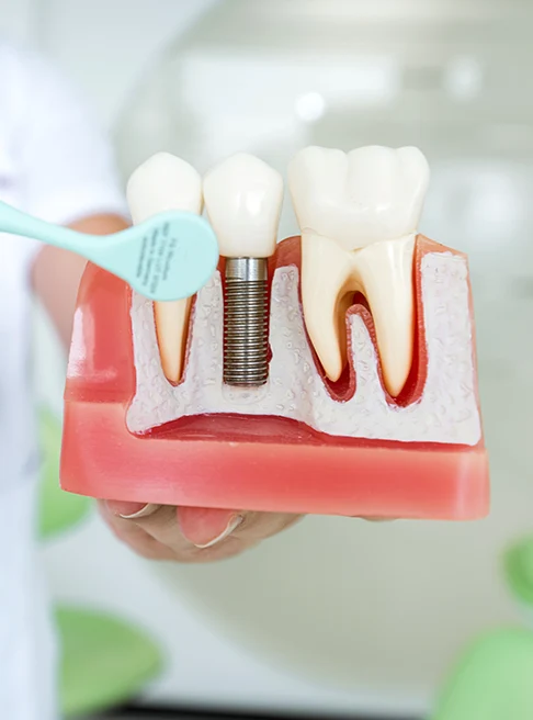 Benefits of Choosing Single Dental Implants