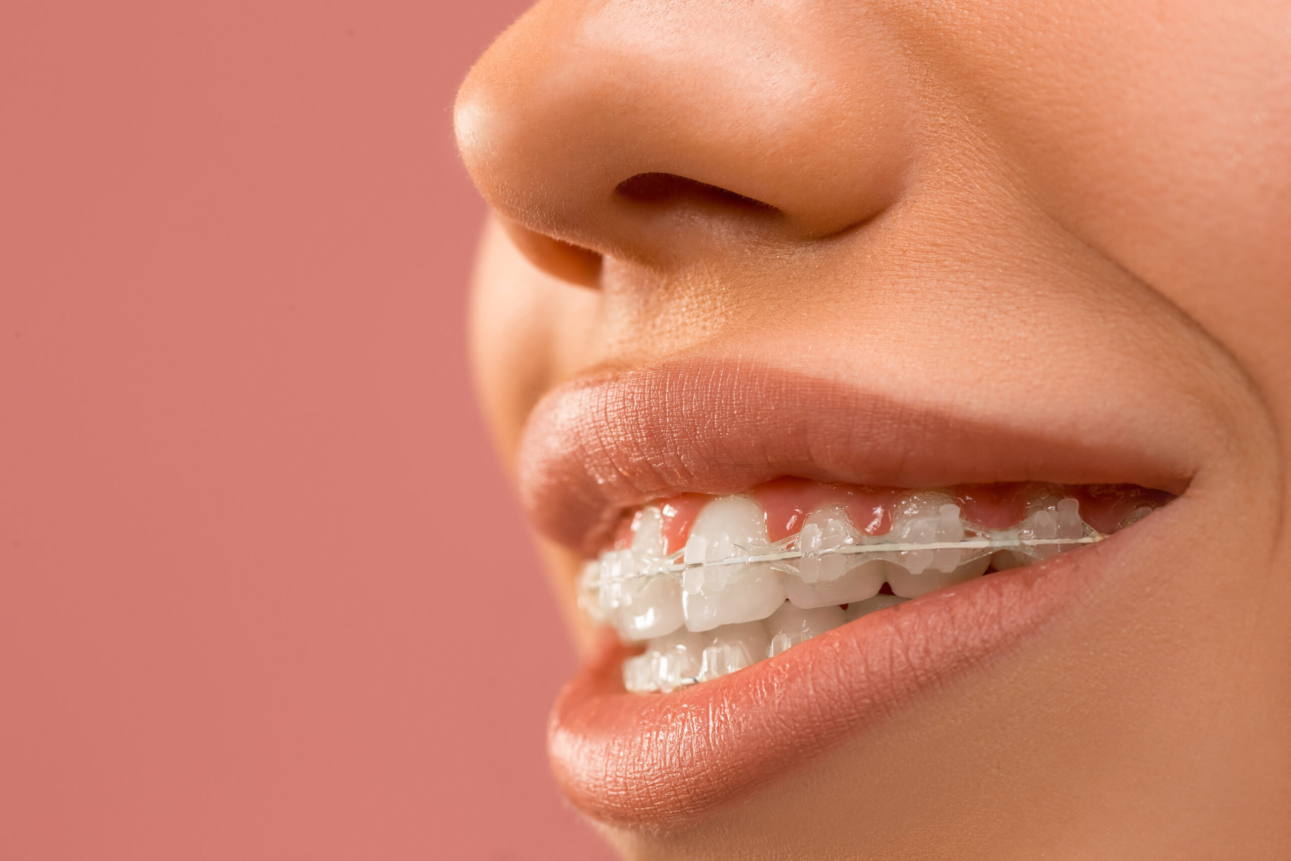 Clear Braces