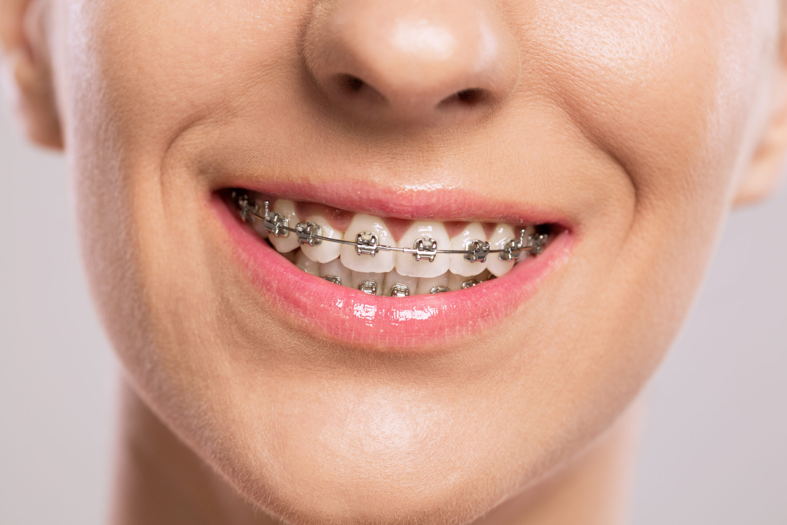 Metal Braces