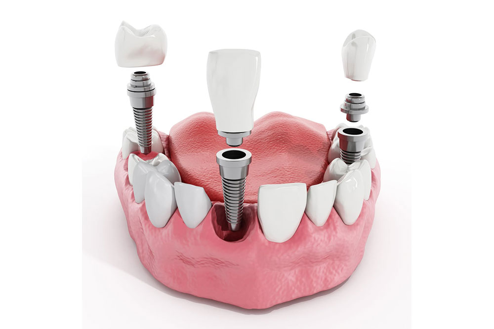 Single Dental Implant